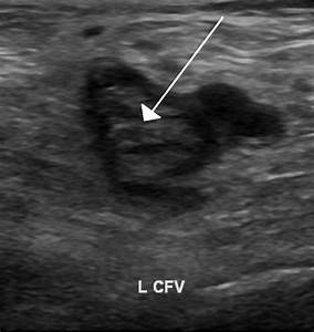 Hints to ultrasound findings given by lab values? - Sononotes